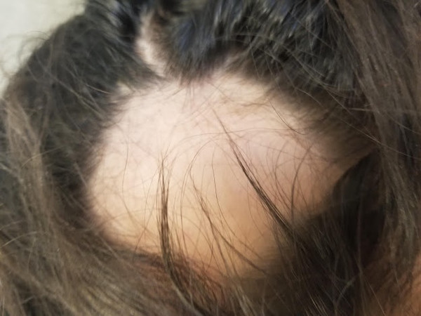 8 year old with patchy distribution of hair loss