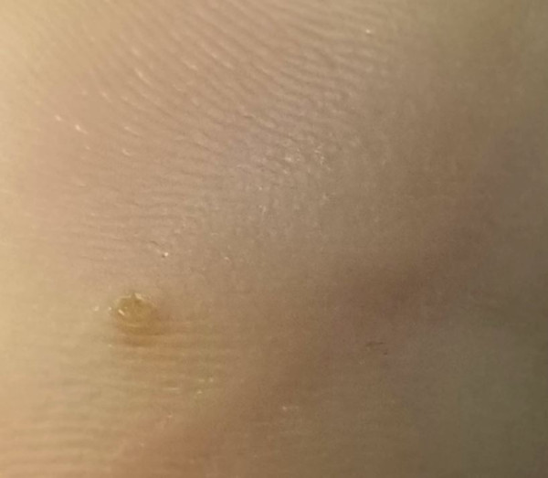Pediatric Board Question Heel Pain