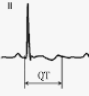 Prolonged QT Prolonged QT