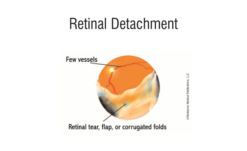 retinal-detaichment.png