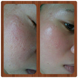 Before and After - DermRollers Can Perfect Skin by Renewing the Surface and Promoting Growth of Healthy Skin and Collagen