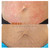 NEW! Meso Stretch Mark Remover - Stimulates Wound Healing and Tissue Regeneration