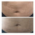 NEW! Meso Stretch Mark Remover - Stimulates Wound Healing and Tissue Regeneration