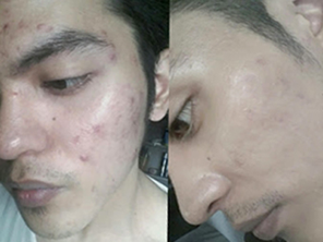 Relumins Professional Acne Clear Set with Acne Fighting Botanicals
