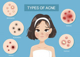 Acne Skin Care Routine