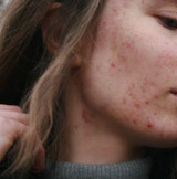 Poor Exfoliation is a Leading Cause of Blackheads and Whiteheads - Common Types of Acne