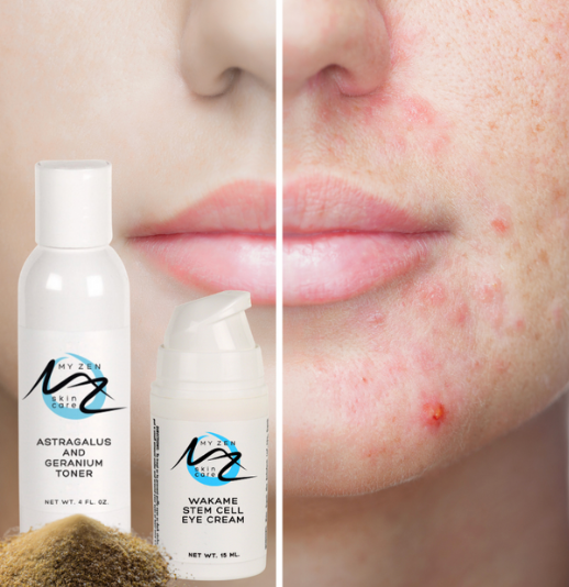 Blemish & Post-Blemish Care Kit

Clearer-looking skin today. Smoother-looking skin tomorrow.

Too often, products for blemish-prone skin focus only on active breakouts while ignoring the visible marks and uneven texture they leave behind. Our Blemish & Post-Blemish Care Kit addresses both concerns with a targeted routine designed to support clearer, healthier-looking skin.

Benefits

    Helps improve the appearance of blemishes and post-blemish marks
    Supports a clearer, more balanced complexion
    Helps calm the appearance of redness
    Promotes smoother-looking skin and more even texture
    Suitable for blemish-prone skin

What's Included

    Astragalus & Geranium Toner
    Acne Clearing Powder
    Wakame Stem Cell Cream
    Frankincense Scar Therapy Oil

How to Use

Step 1: Cleanse skin morning and evening. (We recommend Pumpkin & Green Tea Cleanser.)

Step 2: Apply Astragalus & Geranium Toner with a cotton round.

Step 3: Mix a small amount of Acne Clearing Powder with Wakame Stem Cell Cream to create a poultice. Apply to areas of concern.

Step 4: Massage a few drops of Frankincense Scar Therapy Oil onto areas with visible post-blemish marks and uneven texture.

Use consistently to support a clearer-looking complexion and healthier-looking skin.
About the Products

Astragalus & Geranium Toner
A refreshing antioxidant-rich toner that helps support balanced, healthy-looking skin while preparing it for the next steps in your routine.

Acne Clearing Powder
A specialized blend of Chinese herbs traditionally used to support healing and help maintain a clearer complexion.

Wakame Stem Cell Cream
Features plant stem cells, niacinamide (Vitamin B3), botanical hyaluronic acid, and MSM to help support healthy-looking skin and improve the appearance of uneven texture.

Frankincense Scar Therapy Oil
A nourishing blend of frankincense, rosehip, ylang ylang, and helichrysum oils designed to help improve the appearance of post-blemish marks and uneven skin texture while supporting healthy skin renewal.
 
Why My Zen Skin Care?

At My Zen Skin Care, we combine Chinese herbal wisdom, botanical ingredients, and modern skin care science to create products that support healthy, beautiful skin throughout every stage of life. Our products are made with naturally derived, ethically sourced, cruelty-free ingredients chosen for their nourishing and antioxidant-rich properties.
Our Promise

    Cruelty-free
    Paraben-free
    Phthalate-free
    Made with botanical ingredients
    Inspired by Chinese herbal wisdom and modern skin care science
    We are also proud to support our community by donating a portion of our proceeds to a local food bank and the Cat Care Society.