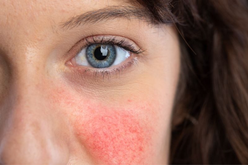 What Happens if Rosacea Is Left Untreated? What Happens if Rosacea Is Left Untreated?