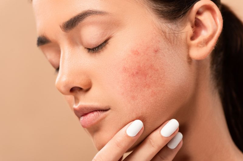 Understanding the Different Grades of Acne