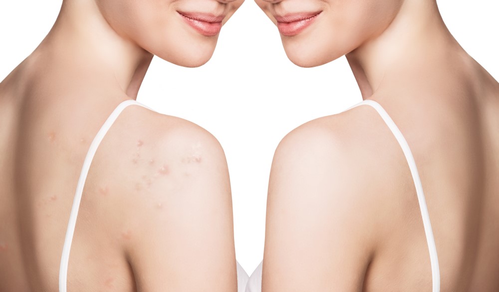 4 Keys to Effectively Eliminate Body Acne