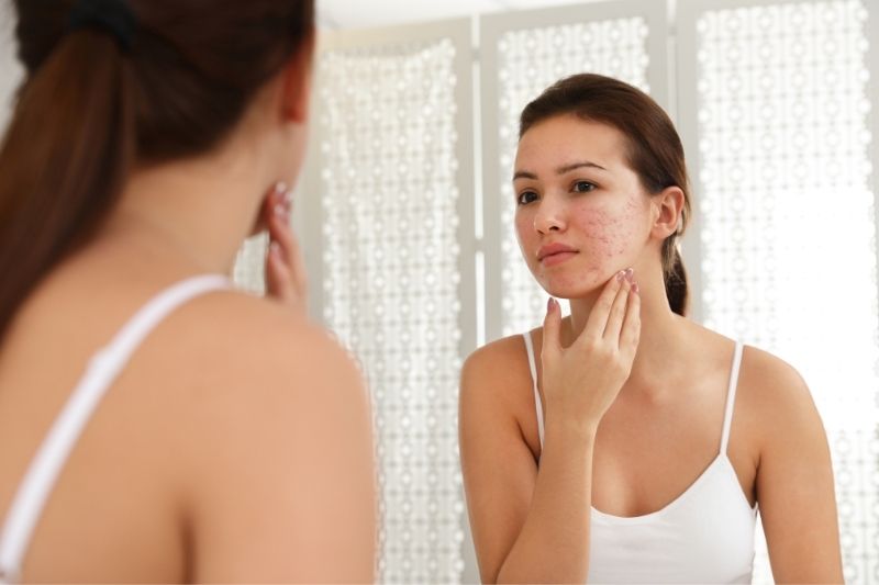 A Guide To Common Types of Advanced Acne