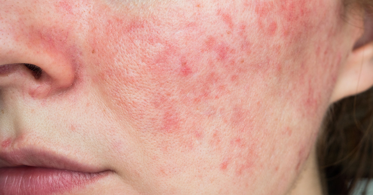Brief Guide To Build a Minimal Skin-Care Routine for Rosacea