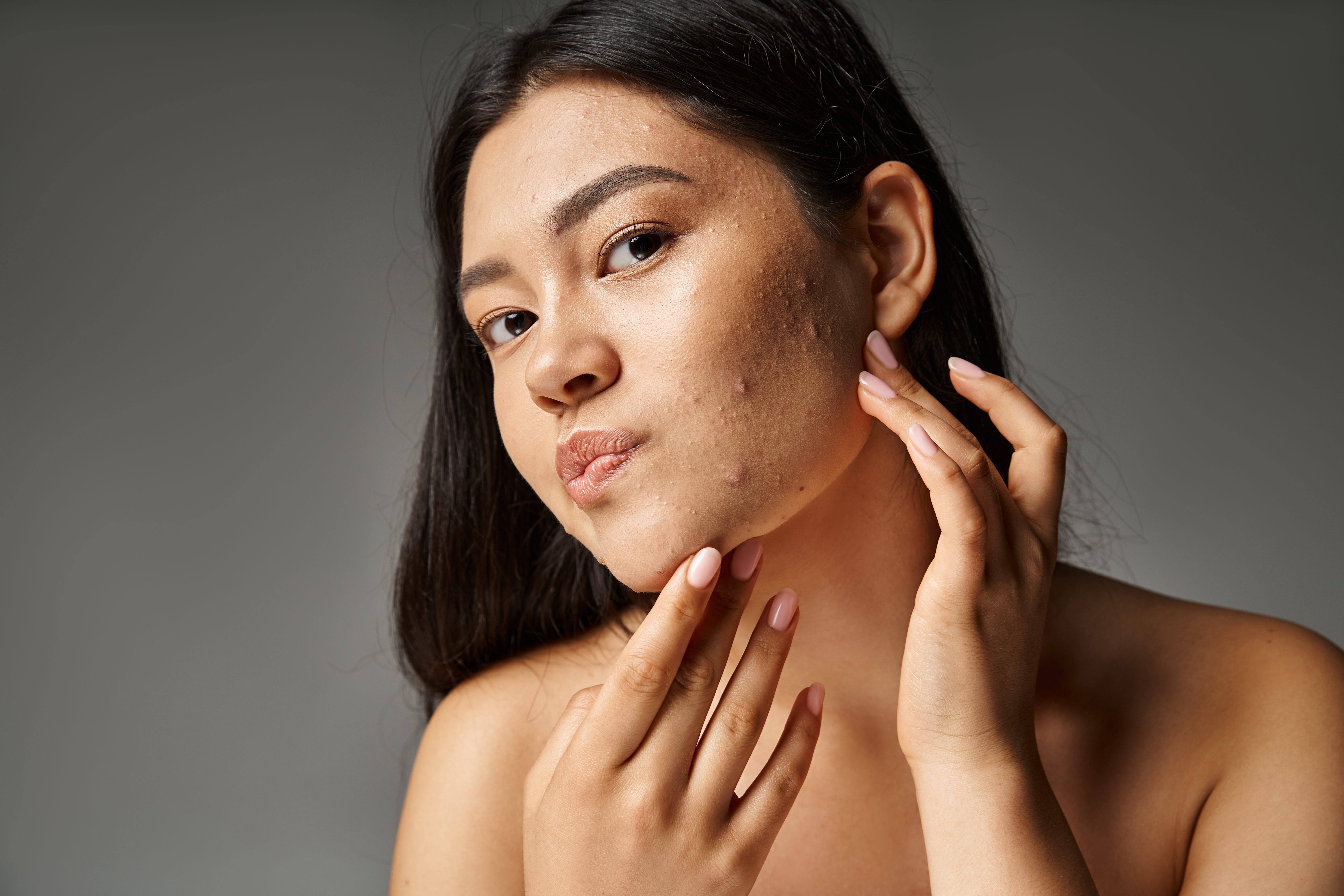 Best Toners for Acne-Prone Skin: What Ingredients to Look For