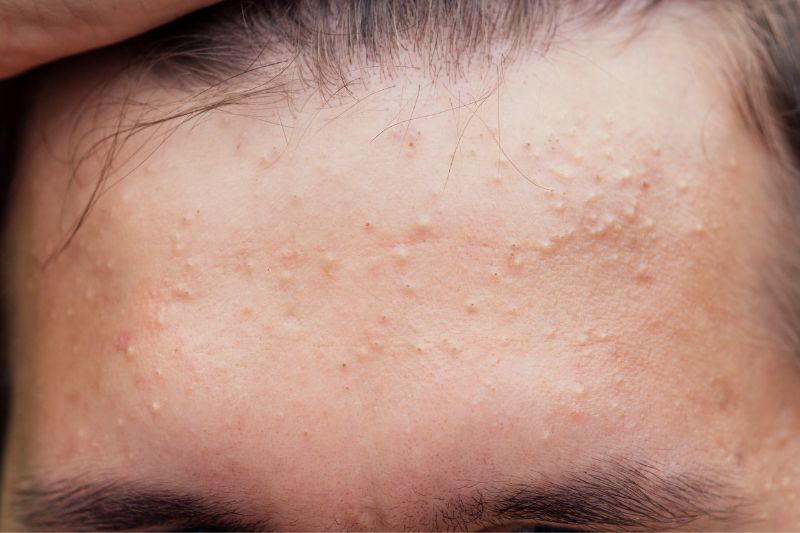 Hormonal vs. Bacterial Acne: How to Tell Which Type You Have