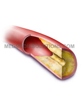 Artery with Atherosclerotic Plaque