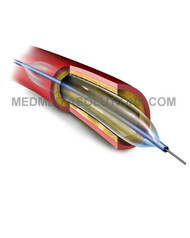 Balloon Angioplasty