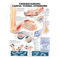 UNDERSTANDING CARPAL TUNNEL SYNDROME CHART 20" W X 26" H, LAMINATED