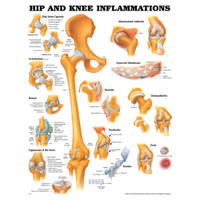 HIP AND KNEE INFLAMMATIONS CHART 20" W X 26" H, LAMINATED