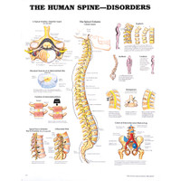 HUMAN SPINE DISORDERS CHART 20" W X 26" H, LAMINATED