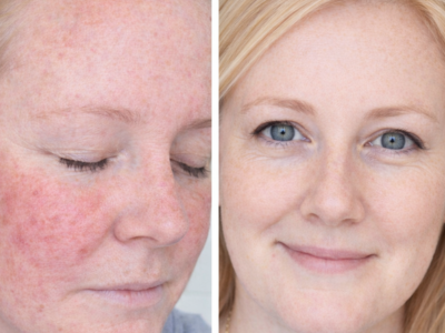What Actually Helps Rosacea Redness? A Simple Skincare Routine for Sensitive Skin