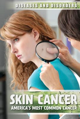Skin Cancer: America's Most Common Cancer (Paperback)