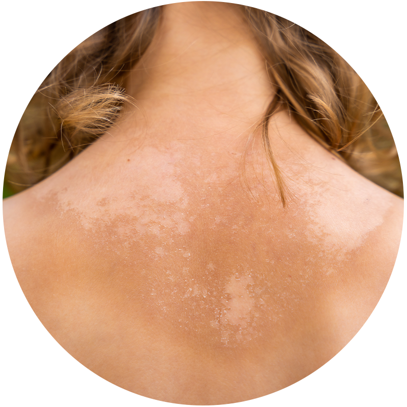 Manchas solares y hormonales