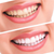 HiWhite Smile Teeth Whitening Kit