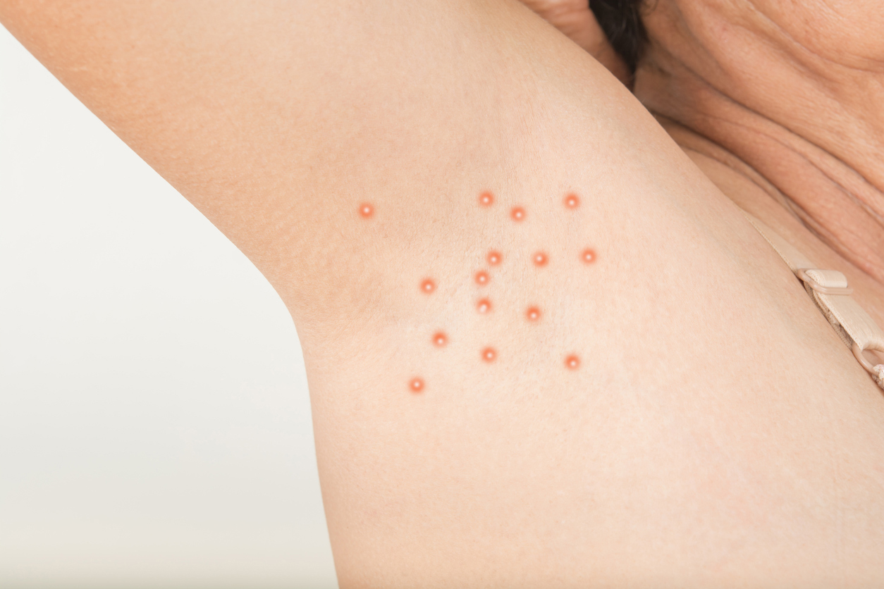 Armpits - the favorite area of ​​folliculitis