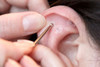 placing ear acupressure pellets in ear
