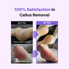 BAREN Foot Callus Eraser Home Kit
