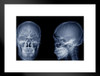 Human Skull X ray Image Front and Side Lateral View Skeleton Anatomy Medical Photo Matted Framed Wall Decor Art Print 20x26