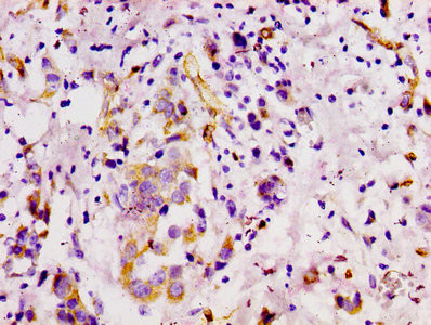 IHC image of CSB-RA013563A0HU diluted at 1:100 and staining in paraffin-embedded human breast cancer performed on a Leica BondTM system. After dewaxing and hydration, antigen retrieval was mediated by high pressure in a citrate buffer (pH 6.0). Section was blocked with 10% normal goat serum 30min at RT. Then primary antibody (1% BSA) was incubated at 4℃ overnight. The primary is detected by a biotinylated secondary antibody and visualized using an HRP conjugated SP system.