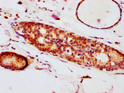 IHC image of CSB-RA007556A209phHU diluted at 1:100 and staining in paraffin-embedded human breast cancer performed on a Leica BondTM system. After dewaxing and hydration, antigen retrieval was mediated by high pressure in a citrate buffer (pH 6.0). Section was blocked with 10% normal goat serum 30min at RT. Then primary antibody (1% BSA) was incubated at 4℃ overnight. The primary is detected by a biotinylated secondary antibody and visualized using an HRP conjugated SP system.