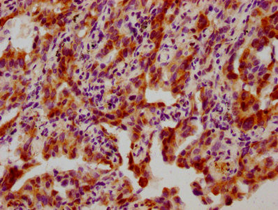 IHC image of CSB-RA010833A82phHU diluted at 1:100 and staining in paraffin-embedded human lung cancer performed on a Leica BondTM system. After dewaxing and hydration, antigen retrieval was mediated by high pressure in a citrate buffer (pH 6.0). Section was blocked with 10% normal goat serum 30min at RT. Then primary antibody (1% BSA) was incubated at 4℃ overnight. The primary is detected by a biotinylated secondary antibody and visualized using an HRP conjugated SP system.
