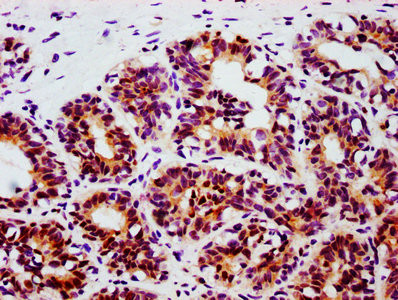 IHC image of CSB-RA022812A705phHU diluted at 1:100 and staining in paraffin-embedded human breast cancer performed on a Leica BondTM system. After dewaxing and hydration, antigen retrieval was mediated by high pressure in a citrate buffer (pH 6.0). Section was blocked with 10% normal goat serum 30min at RT. Then primary antibody (1% BSA) was incubated at 4℃ overnight. The primary is detected by a biotinylated secondary antibody and visualized using an HRP conjugated SP system.