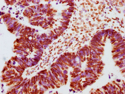 IHC image of CSB-RA011931A100phHU diluted at 1:100 and staining in paraffin-embedded human ovarian cancer performed on a Leica BondTM system. After dewaxing and hydration, antigen retrieval was mediated by high pressure in a citrate buffer (pH 6.0). Section was blocked with 10% normal goat serum 30min at RT. Then primary antibody (1% BSA) was incubated at 4℃ overnight. The primary is detected by a biotinylated secondary antibody and visualized using an HRP conjugated SP system.