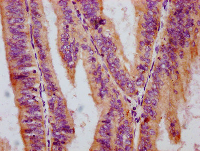 IHC image of CSB-RA019284A259phHU diluted at 1:100 and staining in paraffin-embedded human endometrial cancer performed on a Leica BondTM system. After dewaxing and hydration, antigen retrieval was mediated by high pressure in a citrate buffer (pH 6.0). Section was blocked with 10% normal goat serum 30min at RT. Then primary antibody (1% BSA) was incubated at 4℃ overnight. The primary is detected by a biotinylated secondary antibody and visualized using an HRP conjugated SP system.