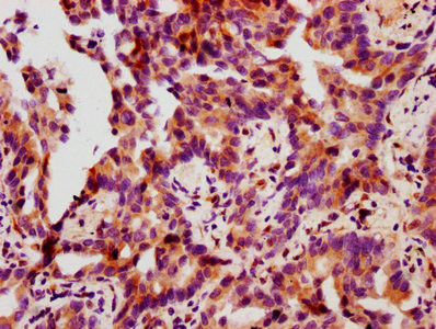 IHC image of CSB-RA010833A78phHU diluted at 1:100 and staining in paraffin-embedded human lung cancer performed on a Leica BondTM system. After dewaxing and hydration, antigen retrieval was mediated by high pressure in a citrate buffer (pH 6.0). Section was blocked with 10% normal goat serum 30min at RT. Then primary antibody (1% BSA) was incubated at 4℃ overnight. The primary is detected by a biotinylated secondary antibody and visualized using an HRP conjugated SP system.
