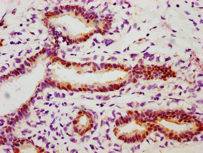 IHC image of CSB-RA010833A78phHU diluted at 1:100 and staining in paraffin-embedded human breast cancer performed on a Leica BondTM system. After dewaxing and hydration, antigen retrieval was mediated by high pressure in a citrate buffer (pH 6.0). Section was blocked with 10% normal goat serum 30min at RT. Then primary antibody (1% BSA) was incubated at 4℃ overnight. The primary is detected by a biotinylated secondary antibody and visualized using an HRP conjugated SP system.
