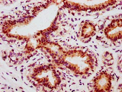 IHC image of CSB-RA011972A63phHU diluted at 1:100 and staining in paraffin-embedded human breast cancer performed on a Leica BondTM system. After dewaxing and hydration, antigen retrieval was mediated by high pressure in a citrate buffer (pH 6.0). Section was blocked with 10% normal goat serum 30min at RT. Then primary antibody (1% BSA) was incubated at 4&deg;C overnight. The primary is detected by a biotinylated secondary antibody and visualized using an HRP conjugated SP system.