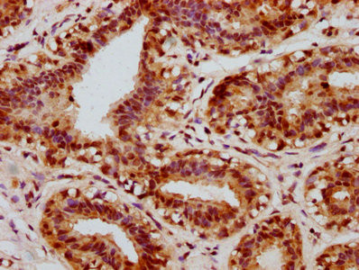 IHC image of CSB-RA005947A133phHU diluted at 1:100 and staining in paraffin-embedded human breast cancer performed on a Leica BondTM system. After dewaxing and hydration, antigen retrieval was mediated by high pressure in a citrate buffer (pH 6.0). Section was blocked with 10% normal goat serum 30min at RT. Then primary antibody (1% BSA) was incubated at 4℃ overnight. The primary is detected by a biotinylated secondary antibody and visualized using an HRP conjugated SP system.