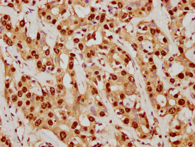 IHC image of CSB-RA022948A0HU diluted at 1:92.5 and staining in paraffin-embedded human liver cancer performed on a Leica BondTM system. After dewaxing and hydration, antigen retrieval was mediated by high pressure in a citrate buffer (pH 6.0). Section was blocked with 10% normal goat serum 30min at RT. Then primary antibody (1% BSA) was incubated at 4℃ overnight. The primary is detected by a biotinylated secondary antibody and visualized using an HRP conjugated SP system.