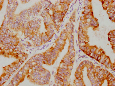 IHC image of CSB-RA015761A0HU diluted at 1:79.75 and staining in paraffin-embedded human endometrial cancer performed on a Leica BondTM system. After dewaxing and hydration, antigen retrieval was mediated by high pressure in a citrate buffer (pH 6.0). Section was blocked with 10% normal goat serum 30min at RT. Then primary antibody (1% BSA) was incubated at 4℃ overnight. The primary is detected by a biotinylated secondary antibody and visualized using an HRP conjugated SP system.
