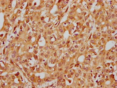 IHC image of CSB-RA011880A0HU diluted at 1:185 and staining in paraffin-embedded human liver cancer performed on a Leica BondTM system. After dewaxing and hydration, antigen retrieval was mediated by high pressure in a citrate buffer (pH 6.0). Section was blocked with 10% normal goat serum 30min at RT. Then primary antibody (1% BSA) was incubated at 4℃ overnight. The primary is detected by a biotinylated secondary antibody and visualized using an HRP conjugated SP system.