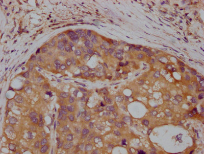 IHC image of CSB-RA983271A0HU diluted at 1:100 and staining in paraffin-embedded human liver cancer performed on a Leica BondTM system. After dewaxing and hydration, antigen retrieval was mediated by high pressure in a citrate buffer (pH 6.0). Section was blocked with 10% normal goat serum 30min at RT. Then primary antibody (1% BSA) was incubated at 4℃ overnight. The primary is detected by a Goat anti-rabbit IgG polymer labeled by HRP and visualized using 0.05% DAB.