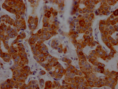 IHC image of CSB-RA934881A0HU diluted at 1:100 and staining in paraffin-embedded human breast cancer performed on a Leica BondTM system. After dewaxing and hydration, antigen retrieval was mediated by high pressure in a citrate buffer (pH 6.0). Section was blocked with 10% normal goat serum 30min at RT. Then primary antibody (1% BSA) was incubated at 4℃ overnight. The primary is detected by a Goat anti-rabbit IgG polymer labeled by HRP and visualized using 0.05% DAB.