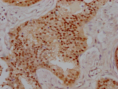 IHC image of CSB-RA176962A0HU diluted at 1:100 and staining in paraffin-embedded human prostate cancer performed on a Leica BondTM system. After dewaxing and hydration, antigen retrieval was mediated by high pressure in a citrate buffer (pH 6.0). Section was blocked with 10% normal goat serum 30min at RT. Then primary antibody (1% BSA) was incubated at 4℃ overnight. The primary is detected by a Goat anti-rabbit IgG polymer labeled by HRP and visualized using 0.05% DAB.
