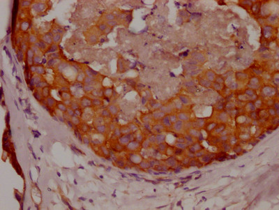 IHC image of CSB-RA951649A0HU diluted at 1:100 and staining in paraffin-embedded human breast cancer performed on a Leica BondTM system. After dewaxing and hydration, antigen retrieval was mediated by high pressure in a citrate buffer (pH 6.0). Section was blocked with 10% normal goat serum 30min at RT. Then primary antibody (1% BSA) was incubated at 4℃ overnight. The primary is detected by a Goat anti-rabbit IgG polymer labeled by HRP and visualized using 0.05% DAB.