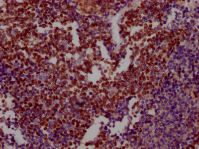 IHC image of CSB-RA276627A0HU diluted at 1:100 and staining in paraffin-embedded human lung cancer performed on a Leica BondTM system. After dewaxing and hydration, antigen retrieval was mediated by high pressure in a citrate buffer (pH 6.0). Section was blocked with 10% normal goat serum 30min at RT. Then primary antibody (1% BSA) was incubated at 4℃ overnight. The primary is detected by a Goat anti-rabbit IgG polymer labeled by HRP and visualized using 0.05% DAB.