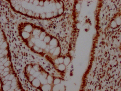 IHC image of CSB-RA792129A0HU diluted at 1:100 and staining in paraffin-embedded human colon cancer performed on a Leica BondTM system. After dewaxing and hydration, antigen retrieval was mediated by high pressure in a citrate buffer (pH 6.0). Section was blocked with 10% normal goat serum 30min at RT. Then primary antibody (1% BSA) was incubated at 4℃ overnight. The primary is detected by a Goat anti-rabbit IgG polymer labeled by HRP and visualized using 0.05% DAB.